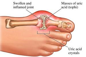 Gout And Inflammation