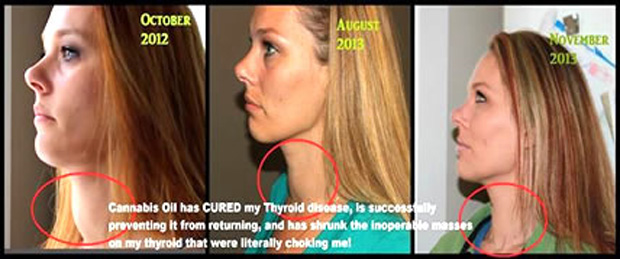 Cannabis Cures - Lindsay Bunn Rogers Heals Her Thyroid Disease And Shrinks Inoperable Mass