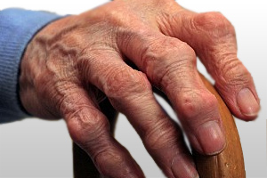 What Is Arthritis? Causes Of Arthritis