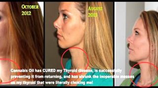 Cannabis Cures - Lindsay Bunn Rogers Heals Her Thyroid Disease And Shrinks Inoperable Mass