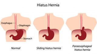 Lack Of Fiber And Hiatal Hernia Feeding Your Acid Reflux