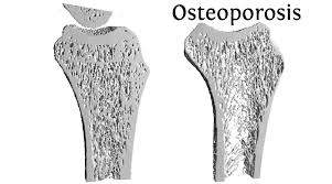 Consuming Phytates Helps Strengthen Bones And Reduce Osteoporosis Risk