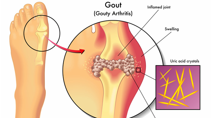 Gout Is A Form Of Arthritis